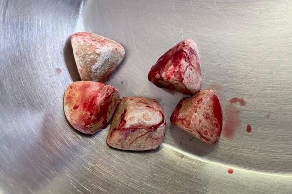 Large Bladder Stones Taken From A Dog